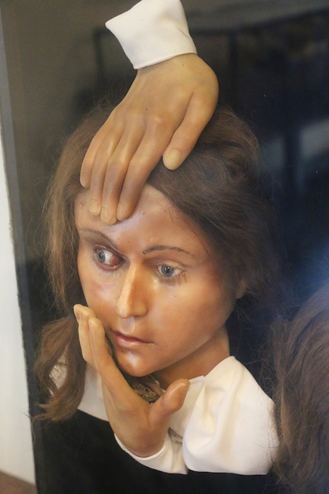 Wax head/bust of an eye surgery patient and the disembodied hands of her surgeon