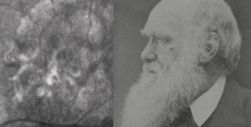 Move over Jesus: Face of Charles Darwin spotted in patient’s eye scan