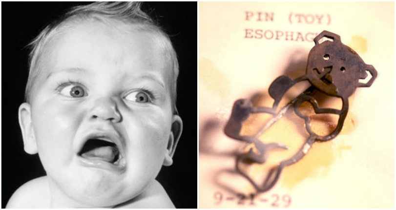 What’s in my mouth? Weird objects that were once swallowed by kids