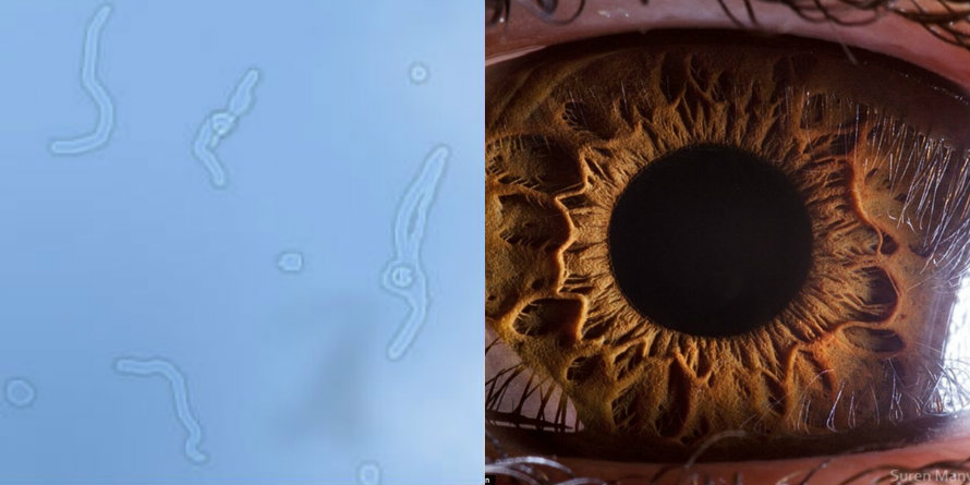 Floaters: So what are those damned moving amoeba things in your eyes, anyway?